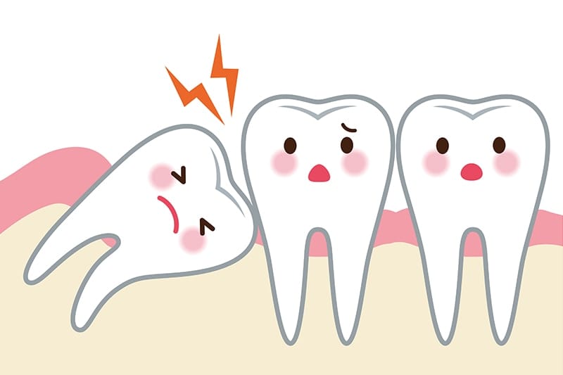 智齿生长位置不正,导致食物堆积而常发炎,形成所谓「牙冠周围炎」.